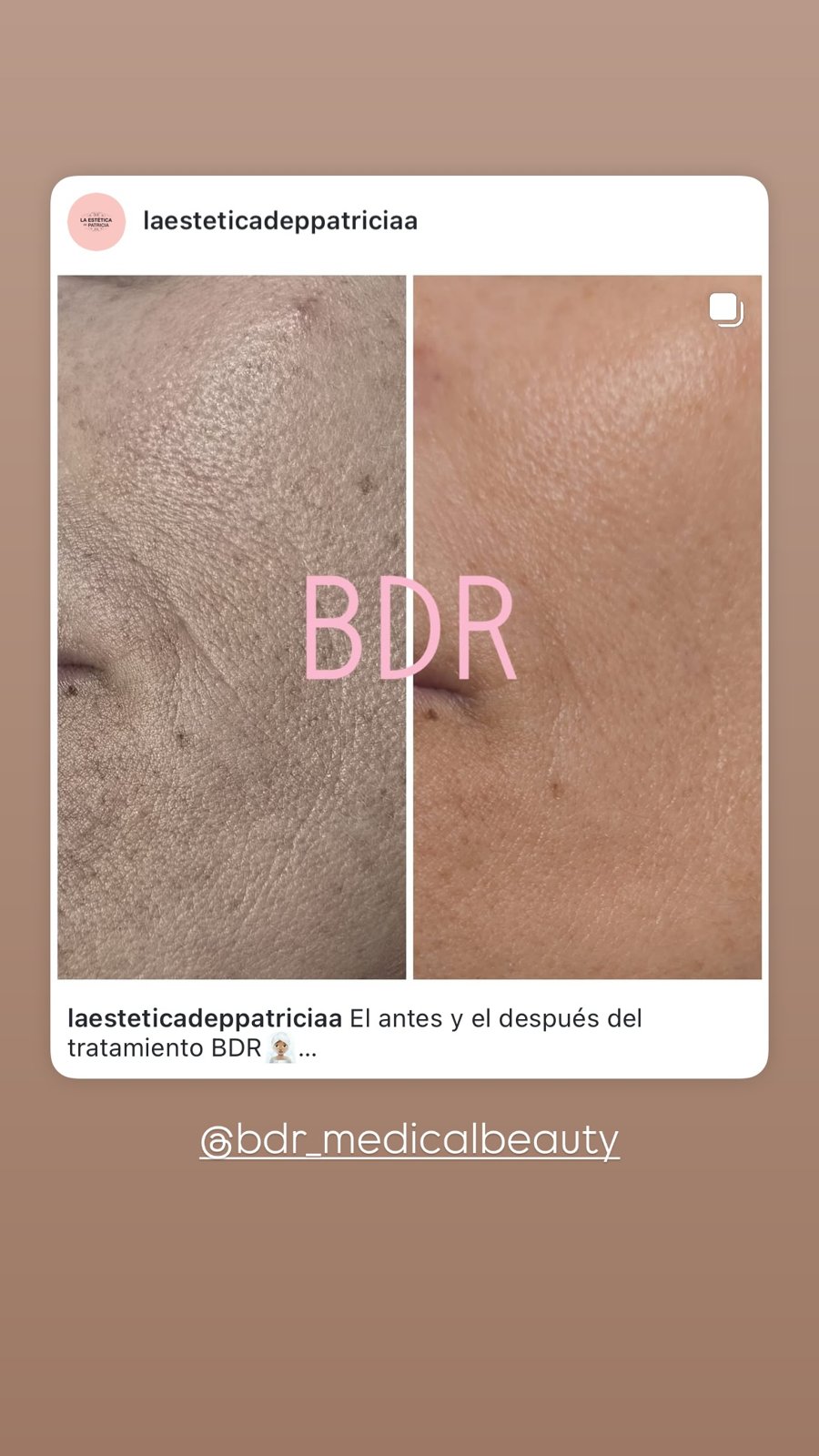 Tratamiento BDR — antes y después